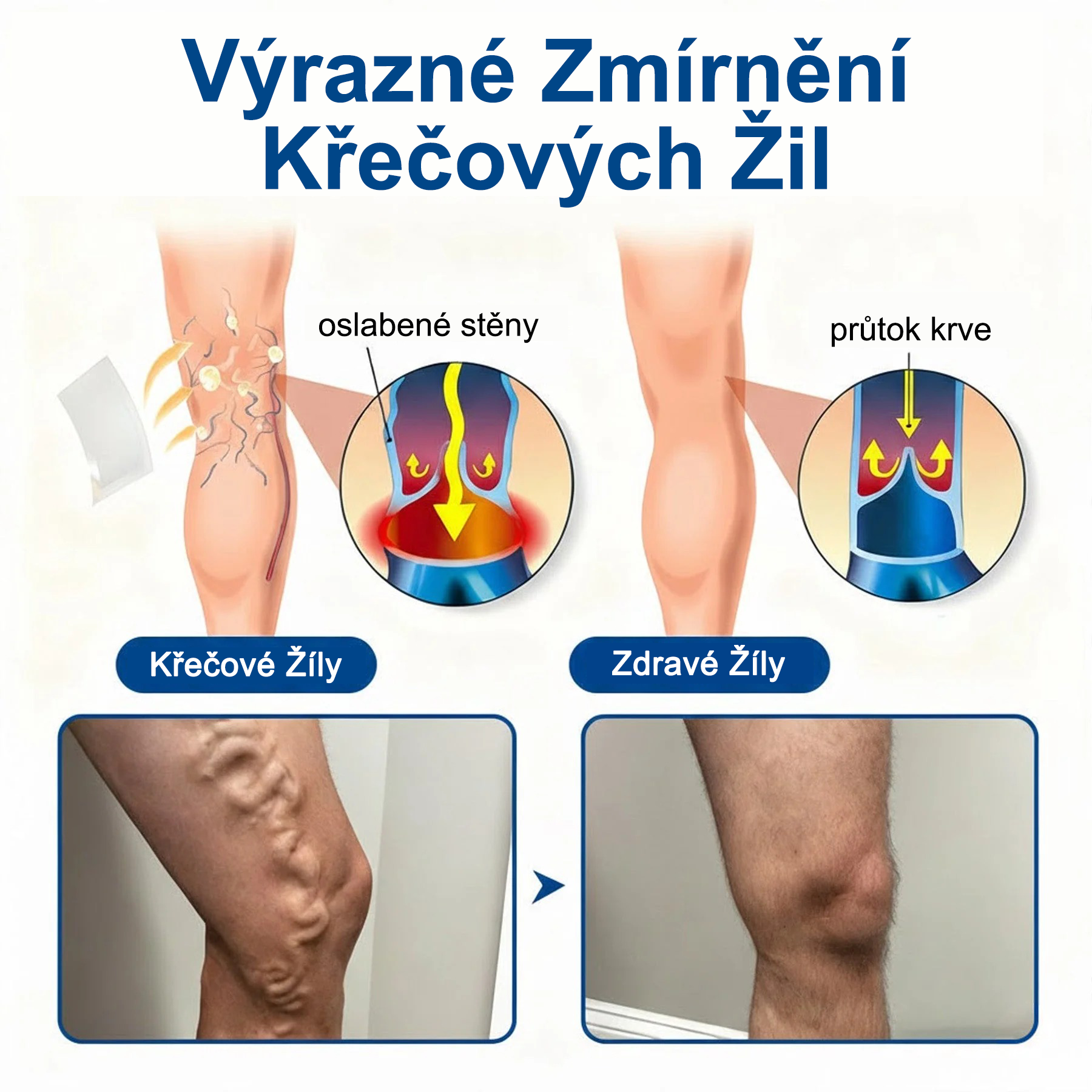 FLORISMA® Klinická mikrojehličková náplast s diosminem a hesperidinem🌿 – zaměřená na křečové a metličkové žilky, pomáhá zmírnit pocit těžkých a unavených nohou